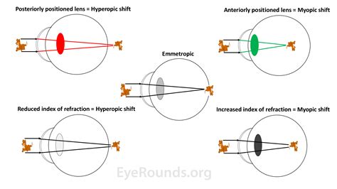 hyperglycemia refractometer|refractive index for diabetic eyes.